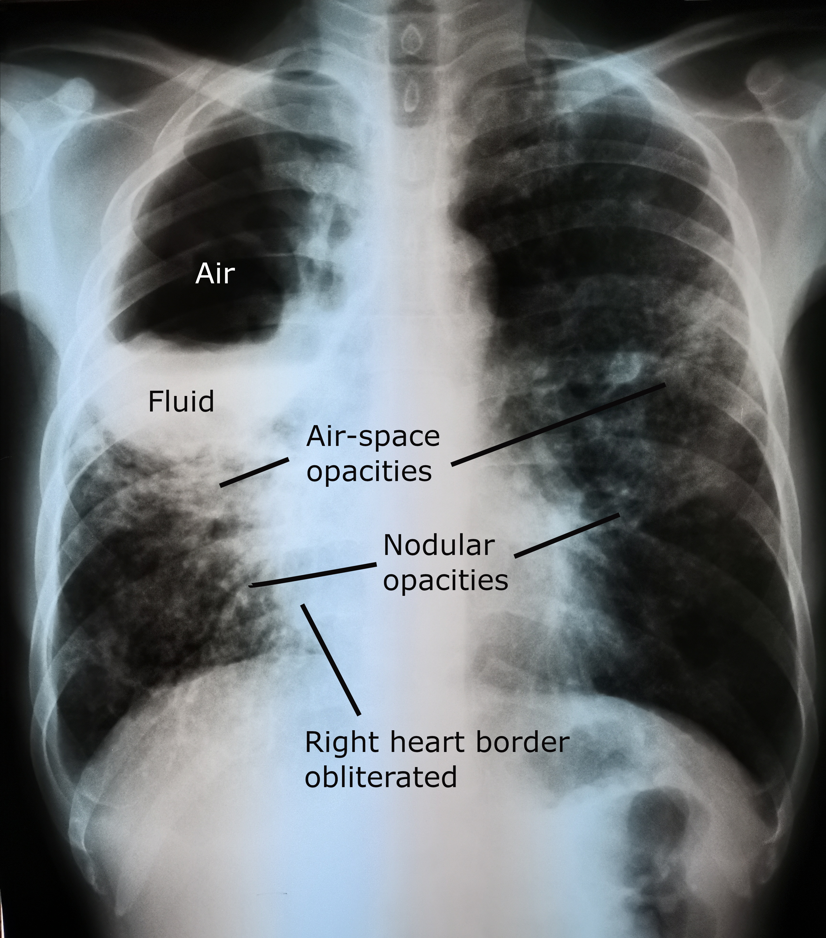 Chest X-ray showing right upper to mid zone lung cavity with air fluid level consistent with lung abscess
