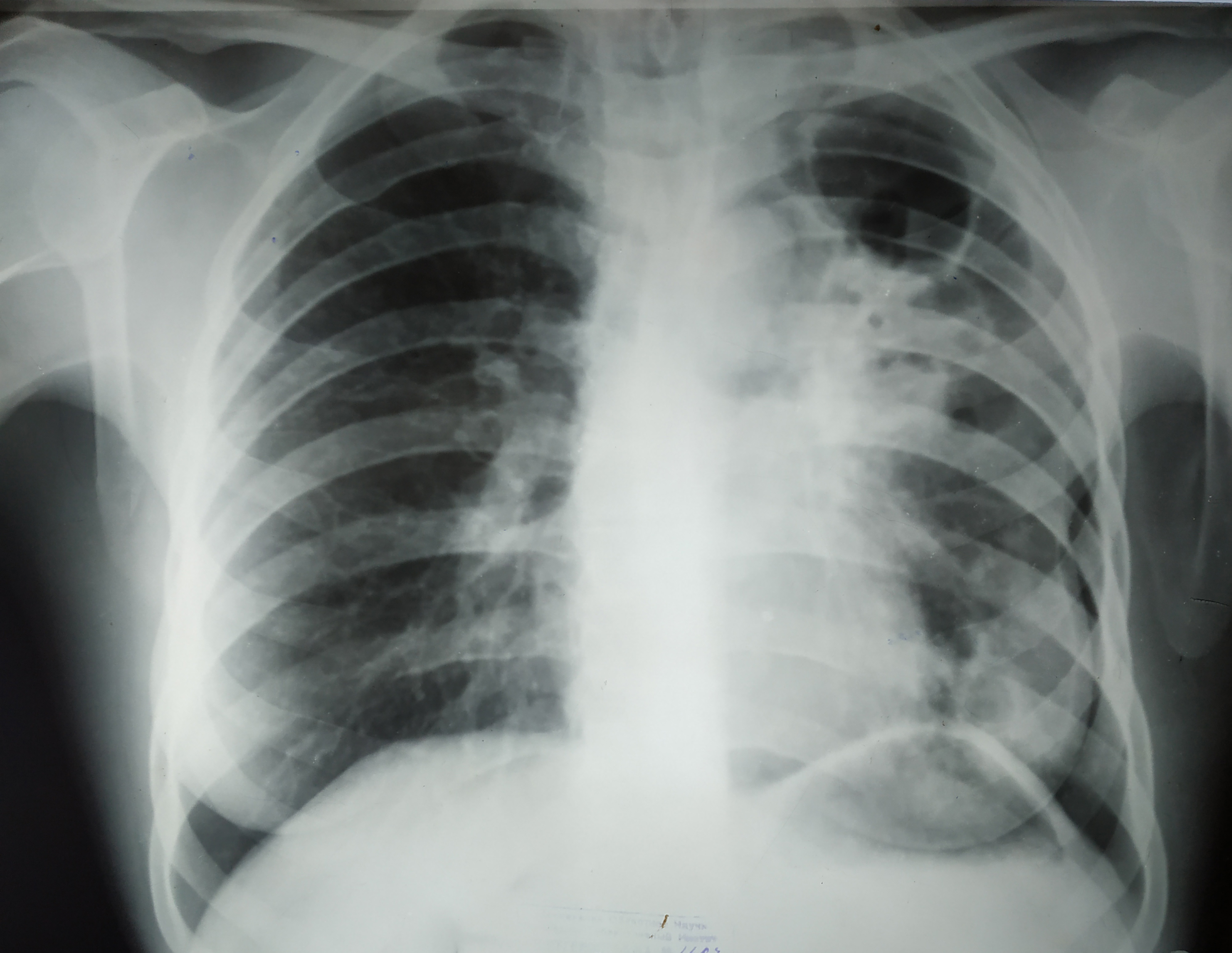 Chest X-ray showing fibrotic cavitary pulmonary tuberculosis with upper lobe cavitation and volume loss